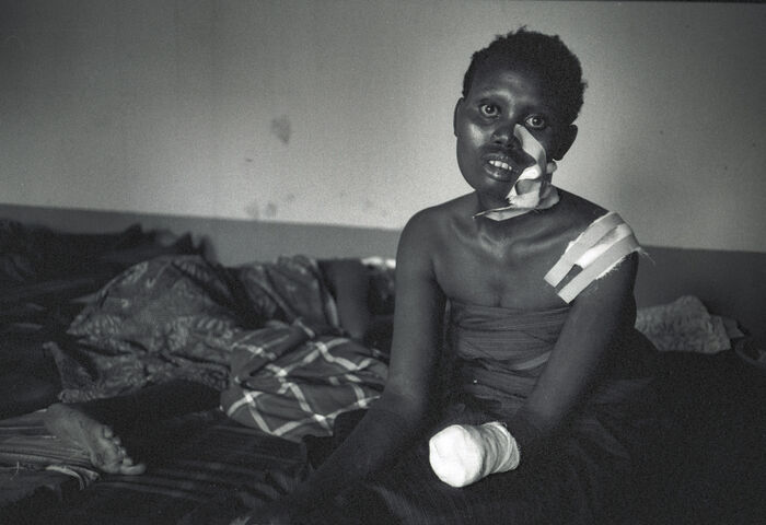 Bilde av kvinne som ble lemlestet under folkemordet i Rwanda.